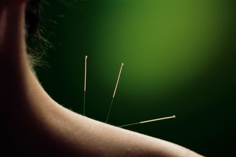 Exploring Dry Needling and Hormone Therapies in Scottsdale